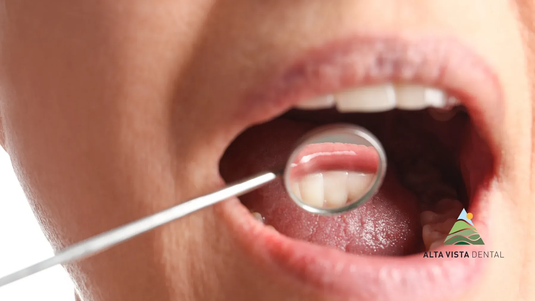 Dental result at Alta Vista Dental Care: Smile rejuvenation