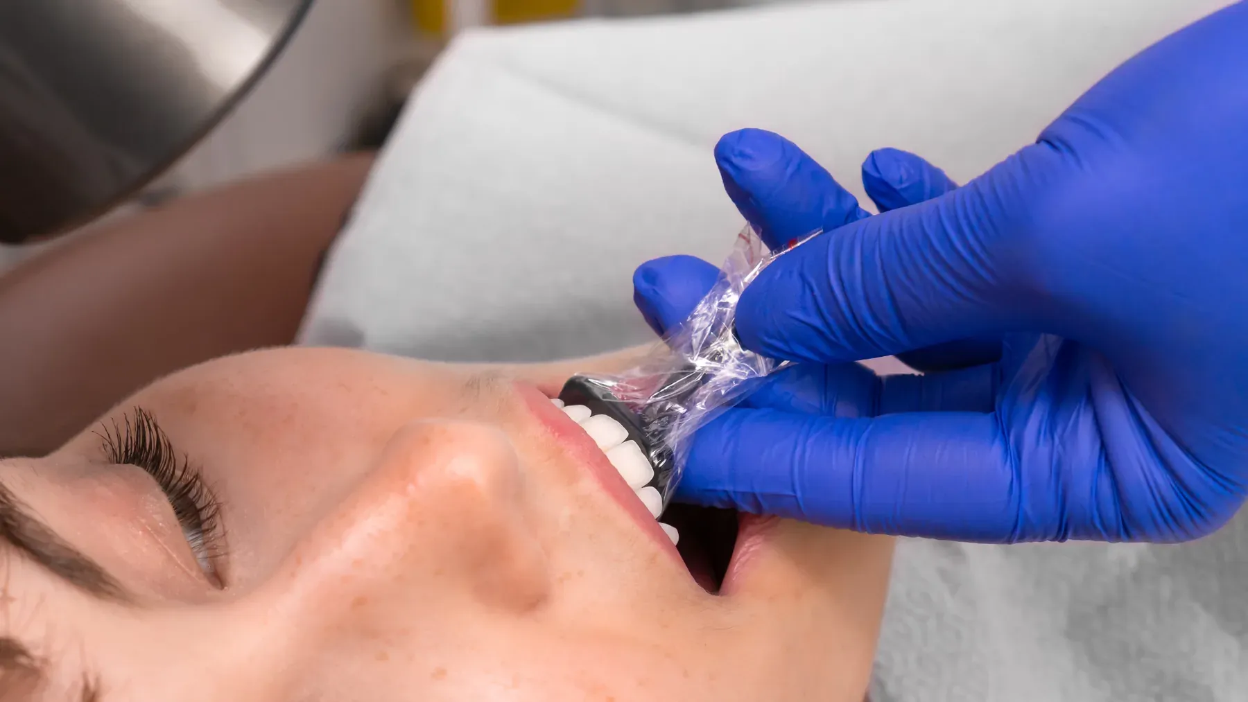 Dental result at Alta Vista Dental Care: Cosmetic bonding & shaping